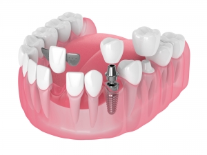 Dental implants in oxnard, ca