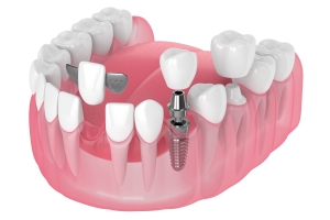 Dental implants in oxnard, ca